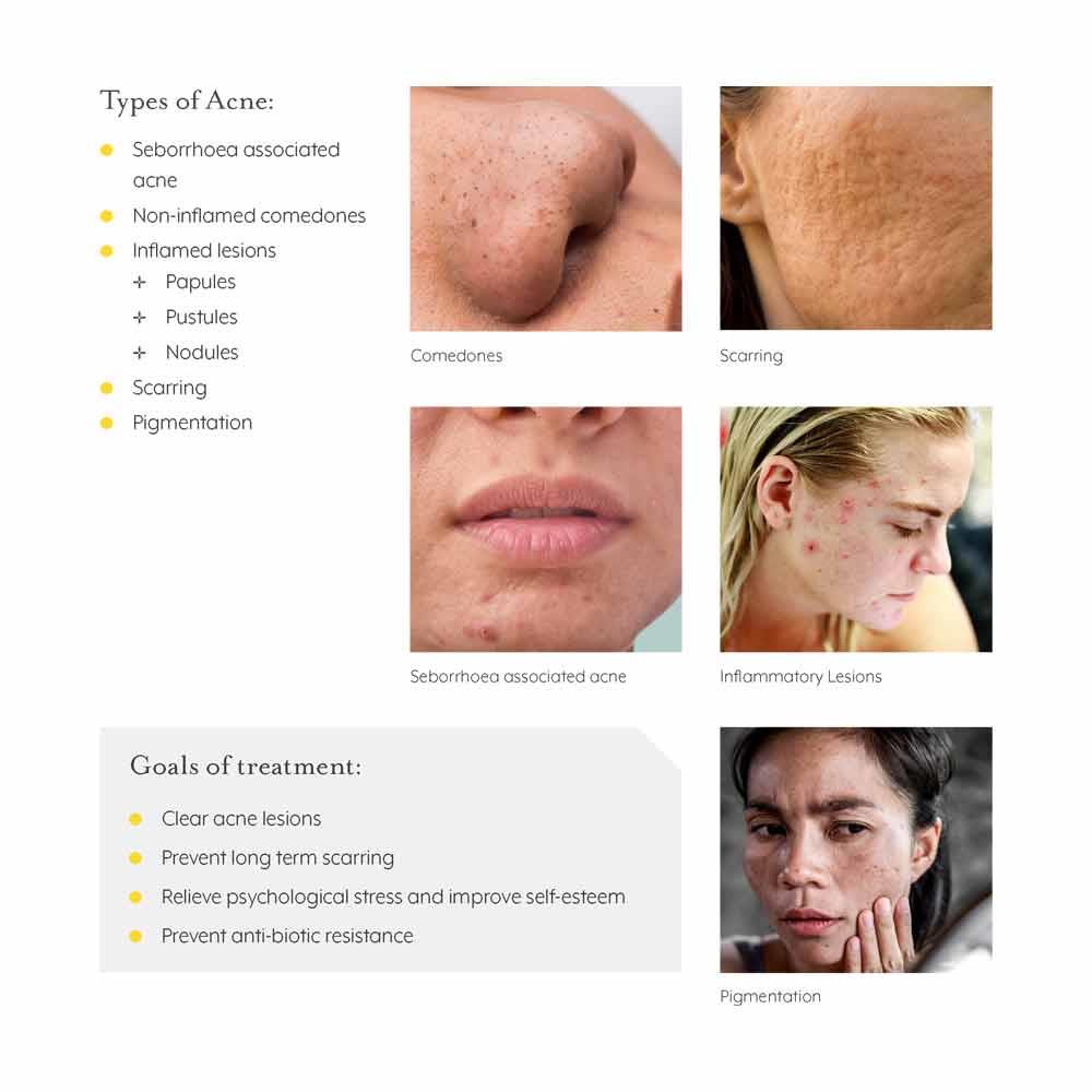 Ceboderm Sebum Regulating Cream For Acne Prone Skin 30ml