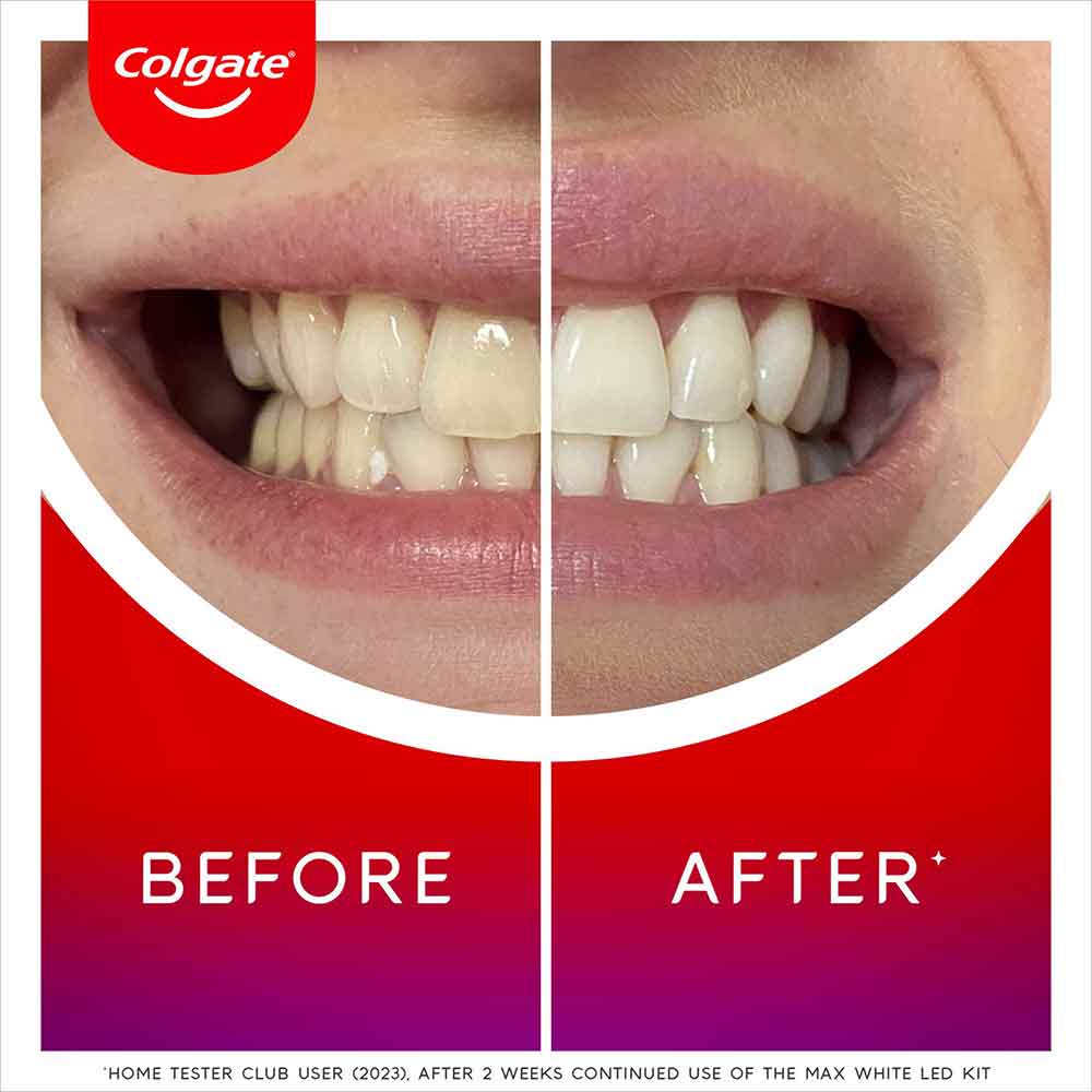 Colgate Max White LED Teeth Whitening Kit