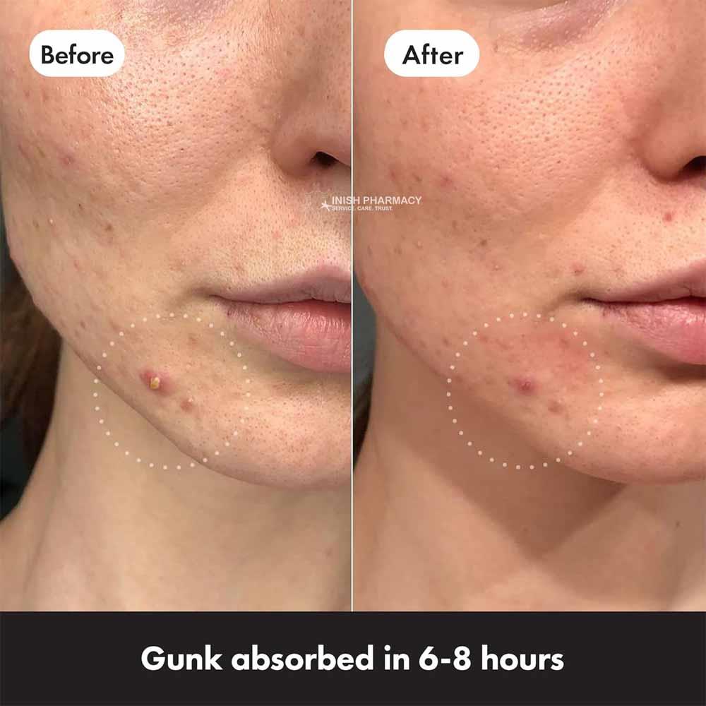 Hero Mighty Patch The Original 36 Pack