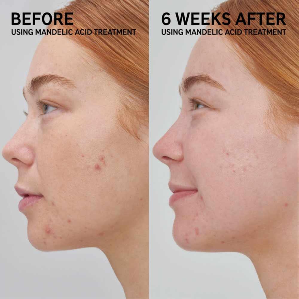 The Inkey List Mandelic Acid Treatment 15ml