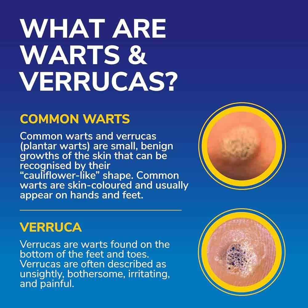 Scholl Freeze Away MAX Verruca & Wart Remover