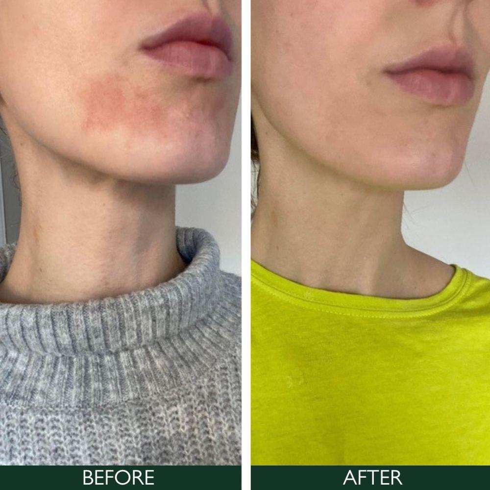 Sorted Skin 5 In 1 Anti-Redness Day Cream SPF50 30ml