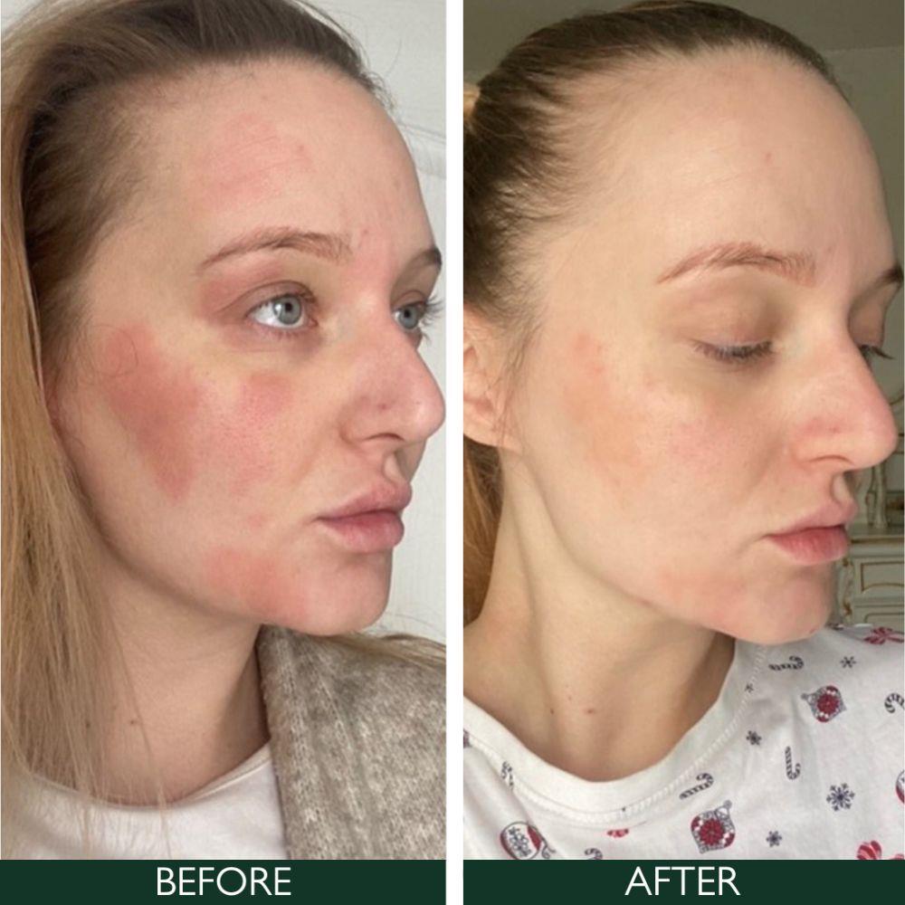 Sorted Skin 5 In 1 Anti-Redness Day Cream SPF50 30ml