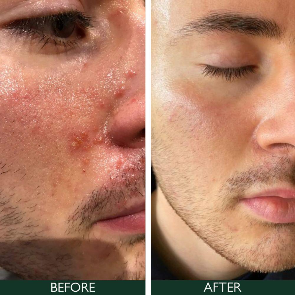 Sorted Skin 5 In 1 Anti-Redness Day Cream SPF50 30ml