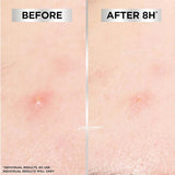 Garnier Pure Active Pimple Patch 22 Pack