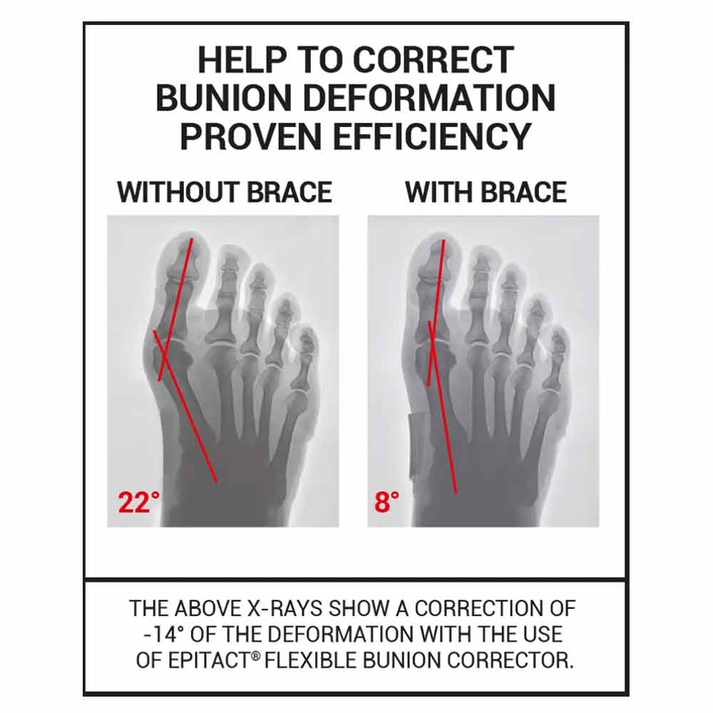 Epitact Flexible Bunion Corrector
