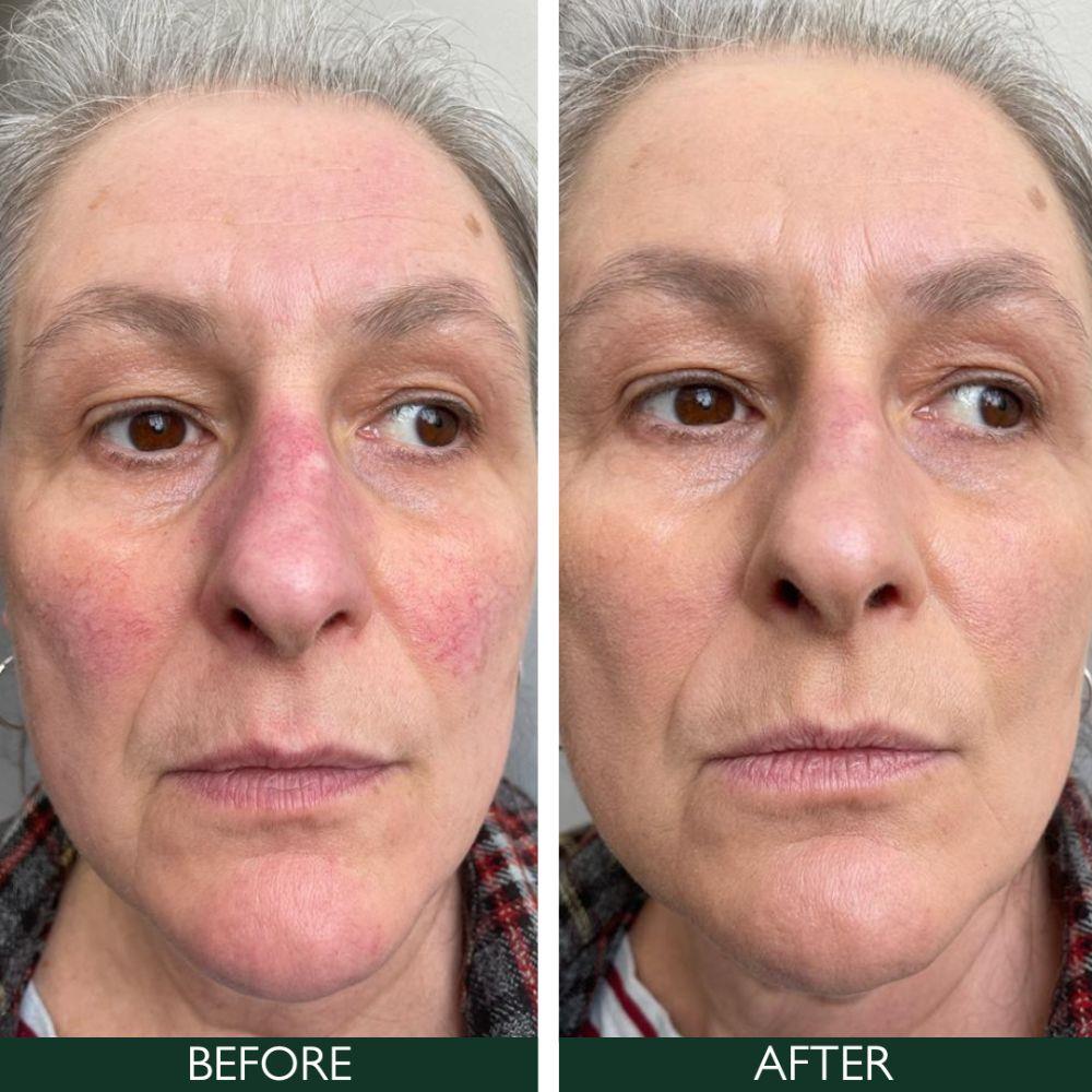 Sorted Skin 5 In 1 Anti-Redness Day Cream SPF50 30ml