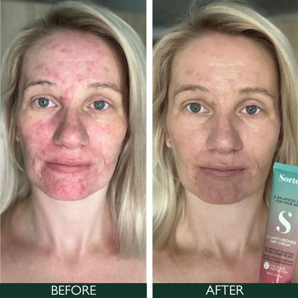 Sorted Skin 5 In 1 Anti-Redness Day Cream SPF50 30ml