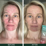 Sorted Skin 5 In 1 Anti-Redness Day Cream SPF50 30ml