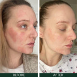 Sorted Skin 5 In 1 Anti-Redness Day Cream SPF50 30ml