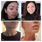 Science of Skin Rescue For Acne Prone Skin & Scars 30ml